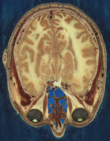 File:Visible-human-brain.png
